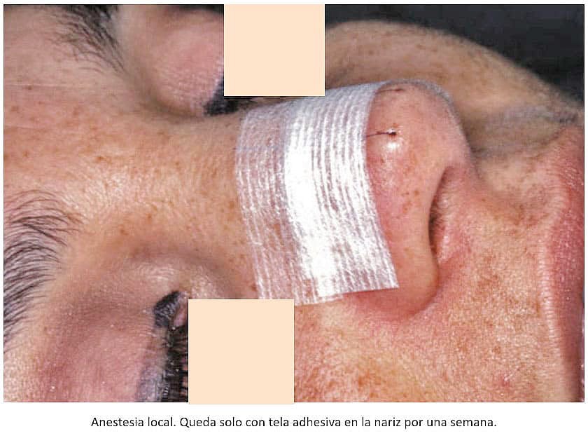 Post operatorio de injerto de punta nasal en rinoplastia secundaria. Dr. De Carolis