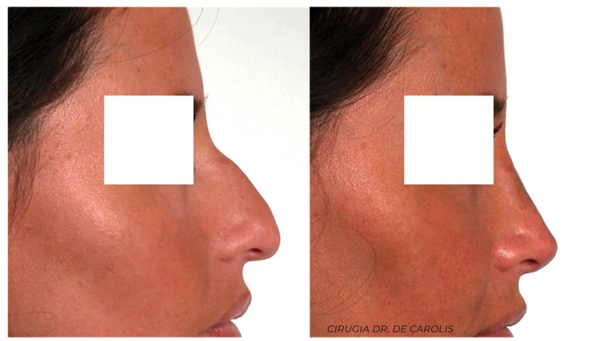 Rinoplastia compleja con resultado estético de perfecta armonía realizada por el Dr. De Carolis.