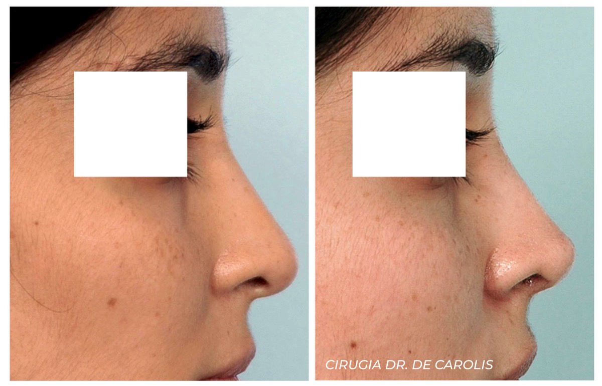 Rinoplastia de preservación dorsal con proyección de punta por Dr. De Carolis. Perfil