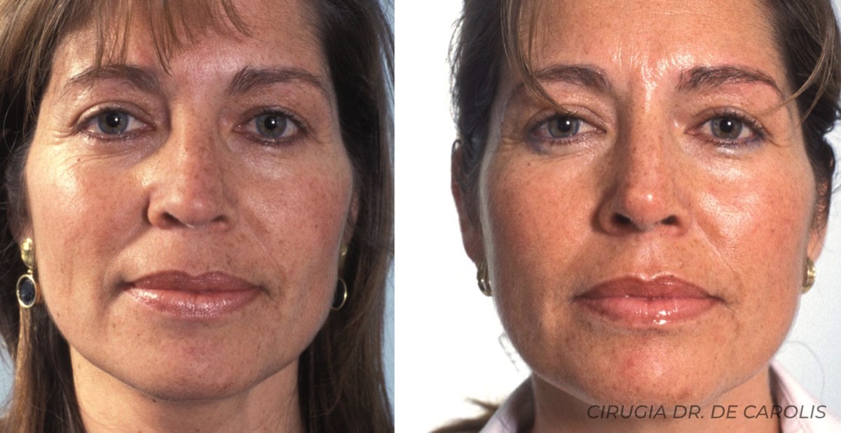 Rinoplastia limitada a la punta nasal, logrando una proyección armoniosa y natural. Vista frontal