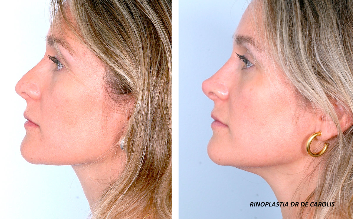 Rinoplastia secundaria con resultado natural y armónico por el Dr. De Carolis. Vista de perfil.